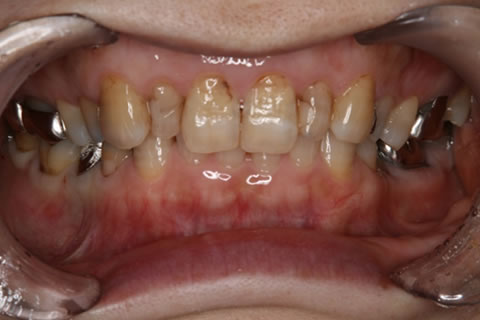 一般歯科：初診時　目立った虫歯はないのに、歯が沁みてしょうがないとおっしゃる患者さん。