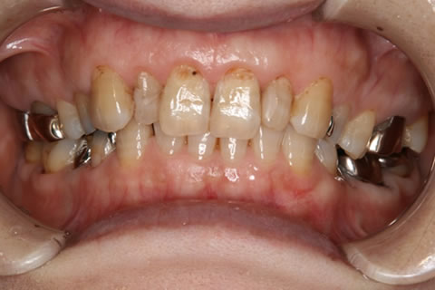一般歯科：治療終了時　習慣的なかみ合わせを改善するだけで今までが嘘のように歯の痛みや頭痛まで消失しました。