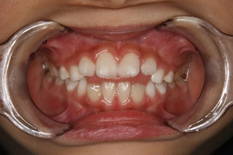 小児歯科：初診時　お口の機能で最も重要なものの一つである燕下が正しくできていない症例です。