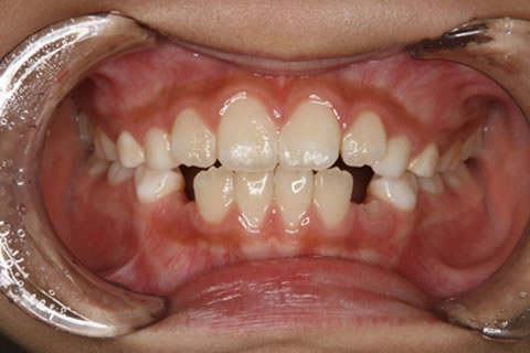 小児歯科：訓練10ケ月後　このように特別な装置を使った矯正をしなくても正しいかみ合わせになってきます。