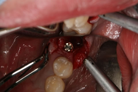 インプラント　抜歯と同時にインプラントを歯槽骨内に埋入しました。